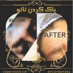پاک کردن تاتو ابرو